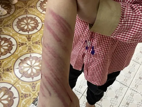 Vụ học sinh lớp 2 nghi bị bạn trai của mẹ bạo hành: Hé lộ lời khai ban đầu