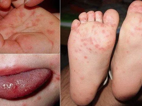 Cuối năm trẻ mắc bệnh tay chân miệng tăng