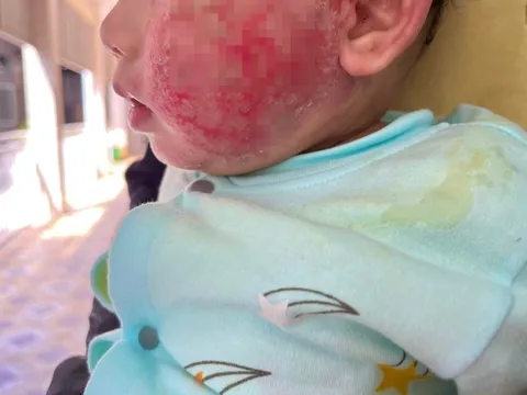 Cha mẹ chủ quan khiến da bé sơ sinh bong tróc, bội nhiễm