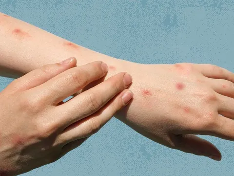 Trung Quốc: Ghi nhận ca nhiễm đậu mua khỉ đầu tiên