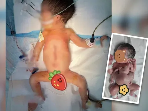 Hy hữu bé trai sinh ra có 4 tay, 4 chân