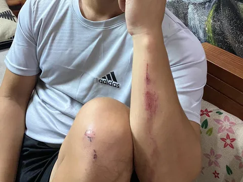 Hà Nội: Nhiều người đi đường bị nhóm đối tượng dùng vỏ chai bia tấn công