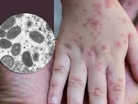 Việt Nam xuất hiện ca bệnh đậu mua khỉ, Bộ Y tế cảnh báo