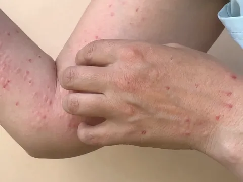 Thắc mắc thường gặp về bệnh đậu mùa khỉ