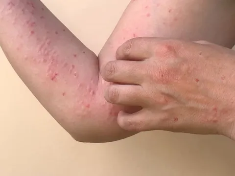 Bệnh nhân mắc đậu mùa khỉ đã có kết quả xét nghiệm âm tính