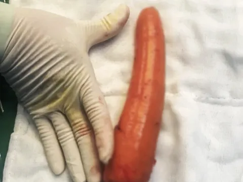 Bình Dương: Cấp cứu thành công thiếu niên nhét củ cà rốt 20cm vào hậu môn để... thử cảm giác lạ