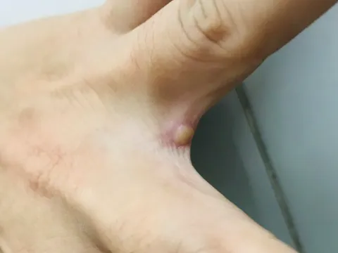 TP.HCM: Phát hiện ca mắc đậu mùa khỉ thứ 2, cũng về từ Dubai