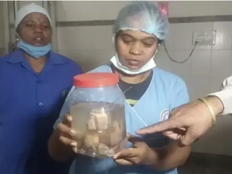 Chuyện lạ có thật: Bé gái Ấn Độ có 8 bào thai trong bụng dù mới 21 ngày tuổi