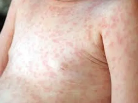 Sốt xuất huyết ở Hà Nội tiến dần đến đỉnh dịch