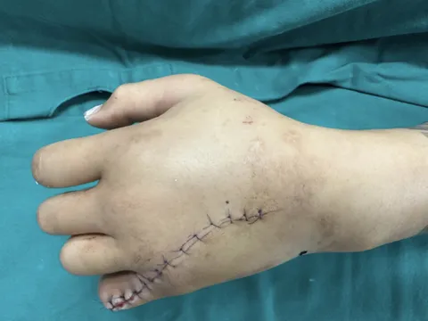 Nối chi dập nát phức tạp cho bệnh nhân 9 tuổi bị tai nạn do nhét tay vào máy giặt