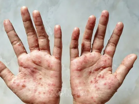 WHO tuyên bố bệnh đậu mùa khỉ không còn là tình trạng khẩn cấp y tế toàn cầu