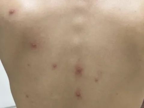 Thêm 1 trường hợp mắc bệnh đậu mùa khỉ ở thành phố Hồ Chí Minh: