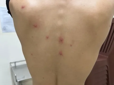 Thành phố Hồ Chí Minh phát hiện ca đậu mùa khỉ thứ 5