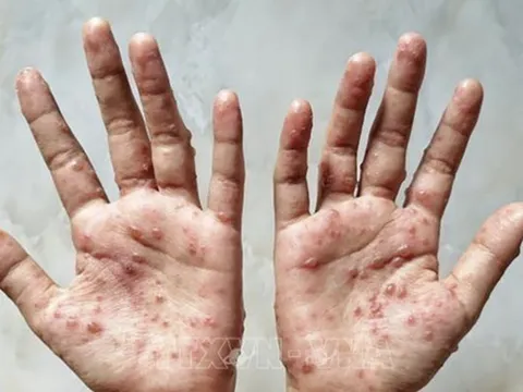 TP Hồ Chí Minh ghi nhận thêm 4 ca mắc đậu mùa khỉ