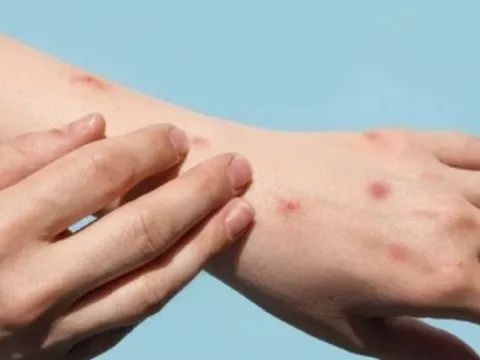 TP Hồ Chí Minh ghi nhận ca đậu mùa khỉ thứ 19