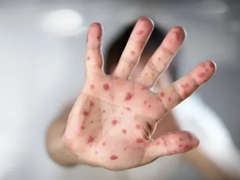 Khu vực phía Nam ghi nhận 117 trường hợp mắc bệnh đậu mùa khỉ