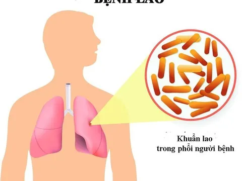 Thủ tướng chỉ đạo tăng cường công tác phòng, chống bệnh Lao