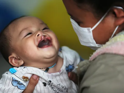 Tìm lại nụ cười cho trẻ bị hở môi, hở hàm ếch