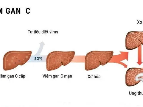 Việt Nam đứng thứ 5 trong 10 quốc gia có tỷ lệ tử vong do ung thư gan cao nhất trên toàn cầu