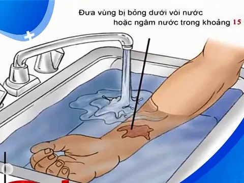Cách sơ cứu, cấp cứu nạn nhân trong đám cháy