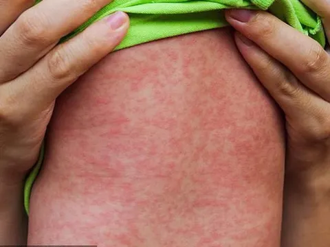 TPHCM đối diện nguy cơ dịch sởi chồng dịch COVID-19, sốt xuất huyết