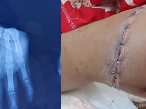 Thiếu niên 12 tuổi bị đứt lìa bàn tay, may mắn được nối lại thành công