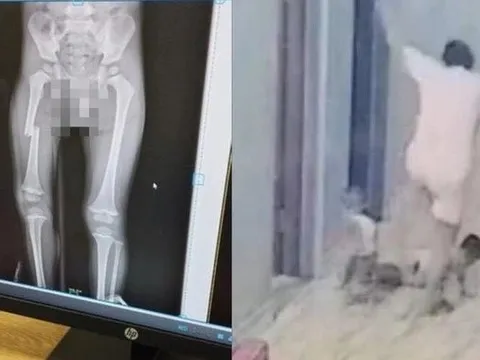 Vụ người mẹ đạp gãy chân con ở Bắc Giang: Cần hiểu đúng về trầm cảm sau sinh