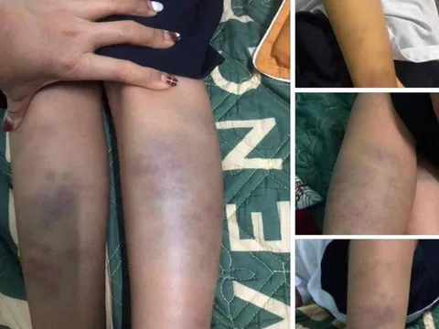 Công an vào cuộc, điều tra vụ học sinh lớp 1 bị đánh bầm tím ở trường