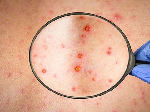 Ca bệnh đậu mùa khỉ thứ hai có khả năng lây ra cộng đồng không?