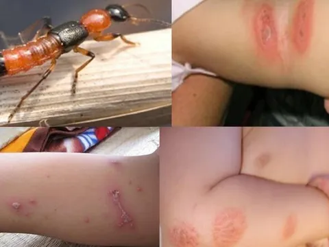 Kiến ba khoang vào mùa, nhiều người nhập viện vì viêm da