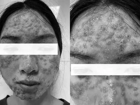 Biến chứng, nhiễm trùng vì chăm sóc da bằng sản phẩm trôi nổi