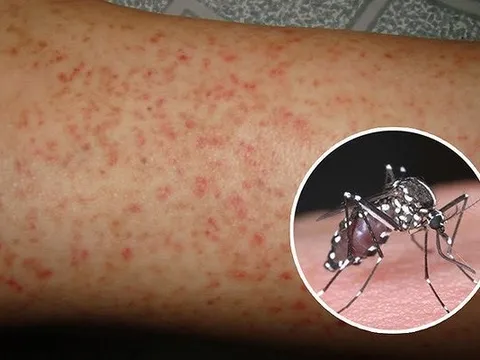 Không có bảo hiểm y tế, bệnh nhân sốt xuất huyết nặng phải chi trả hàng trăm triệu đồng