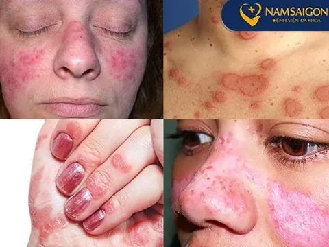 Dùng đơn thuốc cũ chữa lupus ban đỏ, cô gái trẻ phải nhập viện cấp cứu