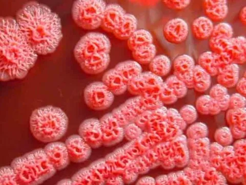 Những biểu hiện lâm sàng thường gặp của bệnh Whitmore