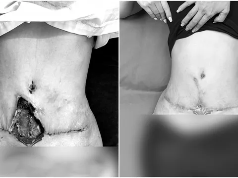 Nữ bệnh nhân bị hoại tử với vết thủng 10cm giữa bụng vì hút mỡ bụng