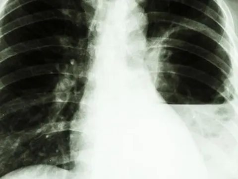 Lý do nhiễm khuẩn Whitmore gây tử vong cao