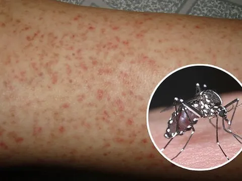 Cao điểm dịch sốt xuất huyết: Chuyên gia cảnh báo, có thể chuyển nặng ngay cả khi không xuất huyết