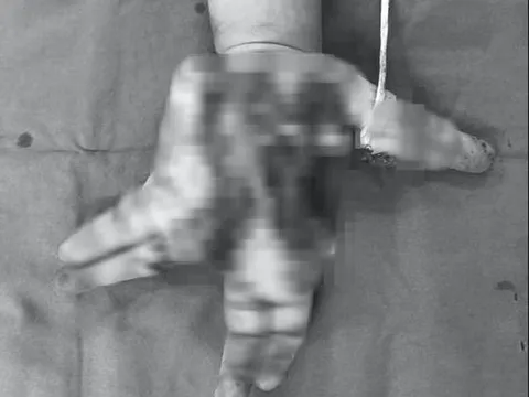 Thiếu niên 14 tuổi bị nát tay do điện thoại bất ngờ phát nổ