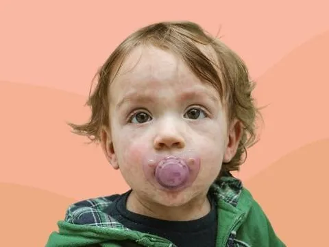 Nguy cơ bùng phát sởi do tỷ lệ tiêm phòng giảm