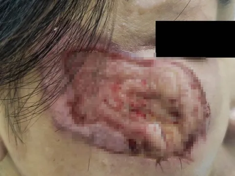 Người phụ nữ nhiễm trùng nặng vì làm đẹp bằng dung dịch a xít