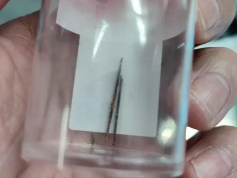 Phát hiện kim khâu quần áo nằm trong phổi bé trai 4 tuổi