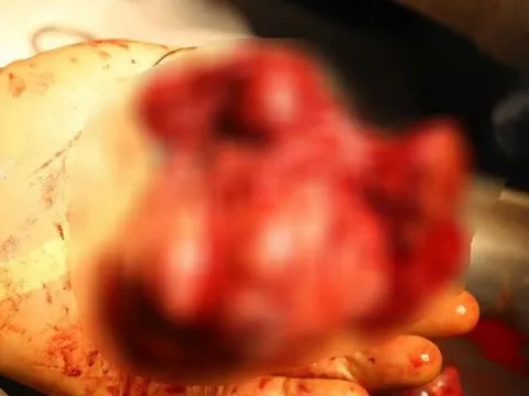 Căn bệnh 'gặm nhấm' 10.000 ca mới mỗi năm ở Việt Nam