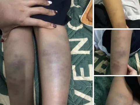 Công an kết luận chính thức vụ học sinh lớp 1 bị đánh bầm tím chân tay ở trường