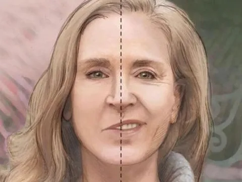 Trời lạnh, đề phòng méo miệng, liệt dây thần kinh số 7 ngoại biên