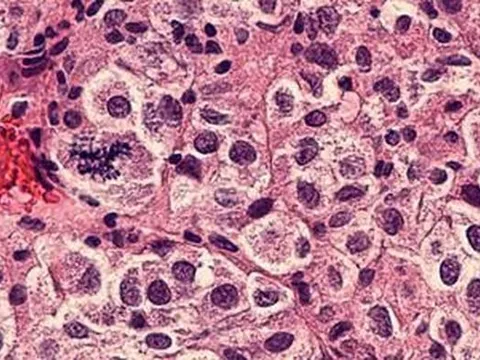 Hãng BioNTech thử nghiệm thuốc điều trị ung thư