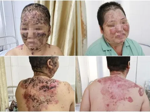 Người phụ nữ bị bệnh da bội nhiễm toàn thân nguy kịch vì tắm lá