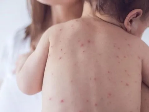 Đắk Lắk ghi nhận 2 ổ dịch thủy đậu mới