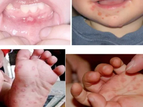 Cần phát hiện và điều trị kịp thời Bệnh tay - chân - miệng