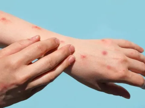 Nguy cơ dịch đậu mùa khỉ bùng phát trên diện rộng ở châu Á là thấp