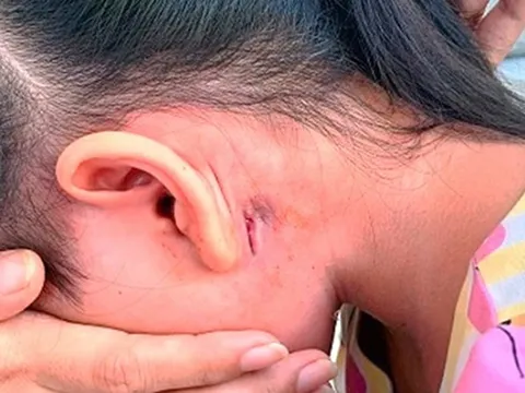 Phát hiện 1 bệnh nhi mắc bệnh "vi khuẩn ăn thịt người" tại Đắk Lắk